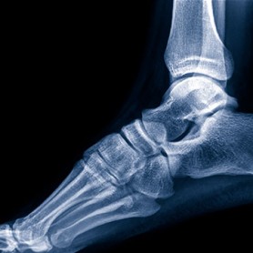 Ankle Replacement