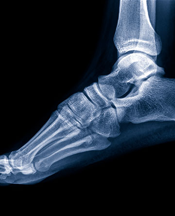 Ankle Replacement