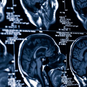 Sports-Related Concussion