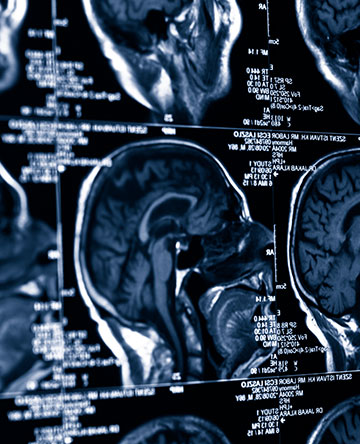 Sports-Related Concussion