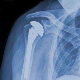 Shoulder Replacement